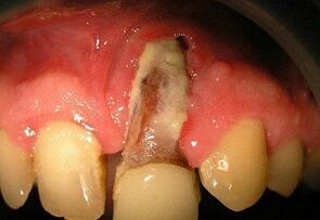 Osteomyelitis no Zänn Extraktioun